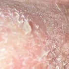 Dry, Flaky Skin
